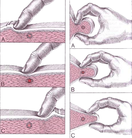Trigger Point Massage