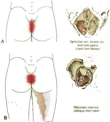 Trigger Points : Obtrator Internus and pelvic floor