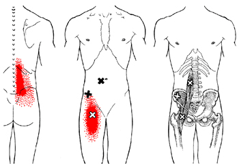 Trigger point - iliopsoas
